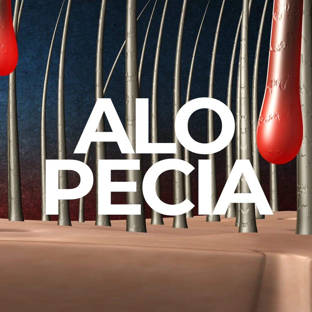 Androgenetische-Alopecia-kl