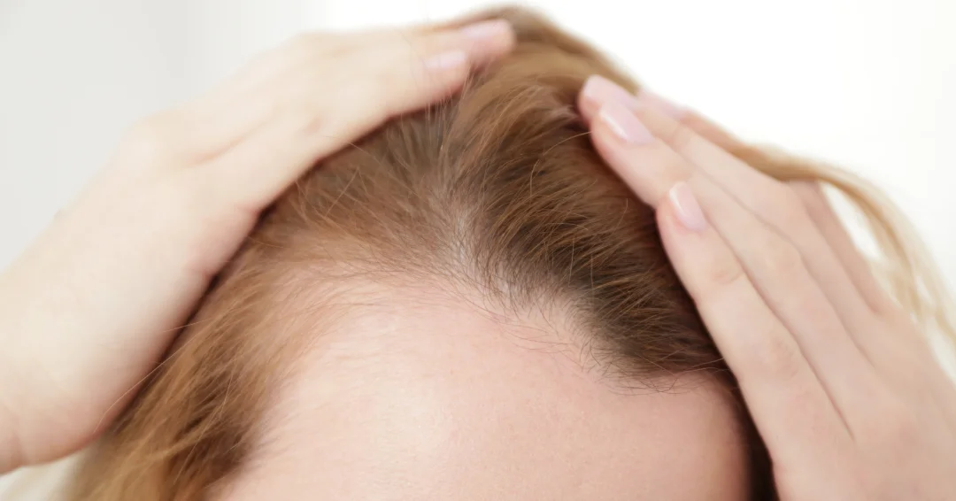 Haaruitval bij vrouwen: ontdek oorzaken, behandelingen en emotionele impact. Leer hoe je haarverlies kunt aanpakken en je zelfvertrouwen kunt herwinnen.